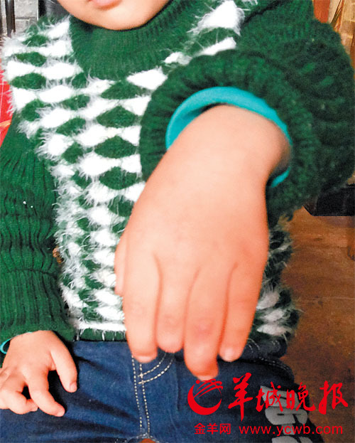 佛山两岁童医院惨断指 欲上诉病历竟被扣