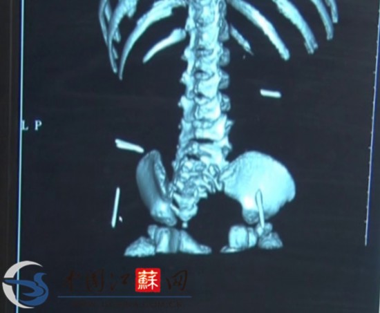 江苏淮安女婴体内取出4根缝衣针 或为人为扎入