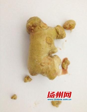 男子肾内取出一块