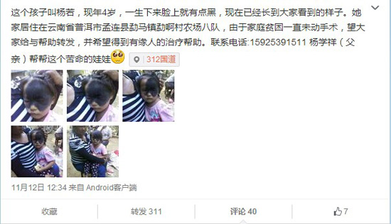 云南孟连“面具女孩”黑斑遮住半张脸 网上求助（图）