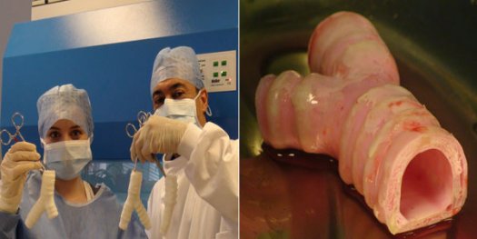医学界新突破:瑞典完成世界首例人造器官移植