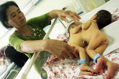 Conjoined twin girls wait for separation