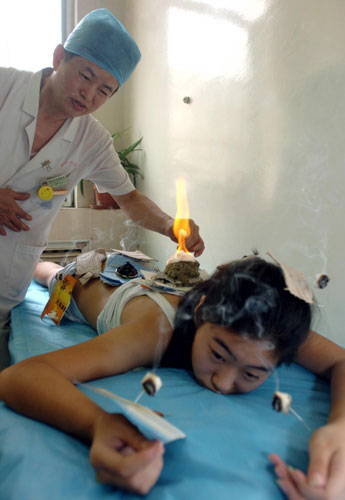 UNESCO bid for acupuncture sets off craze